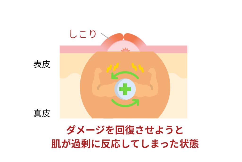 しこりやケロイドができる原因