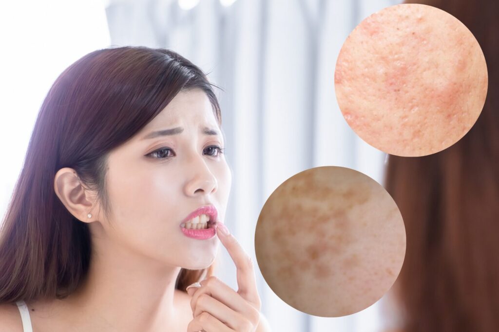 シミ?ニキビ跡?原因別にケアと治療を整理