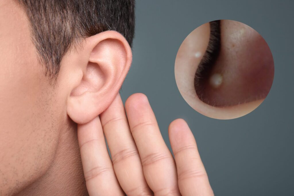 耳の中にできるニキビはなぜ？原因と治し方