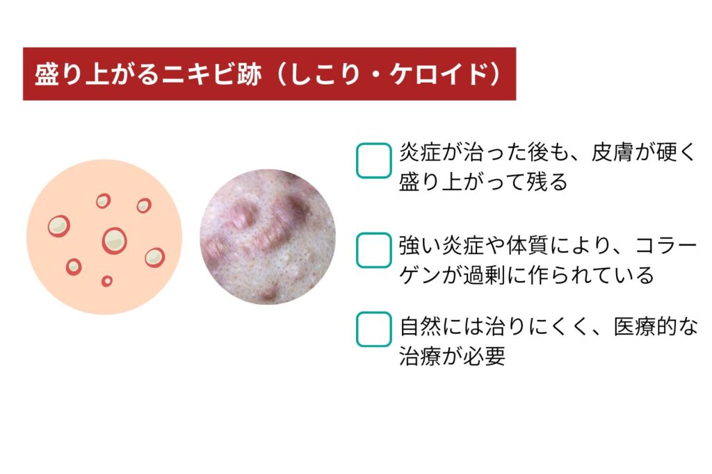 盛り上がるニキビ跡(しこり・ケロイド)
