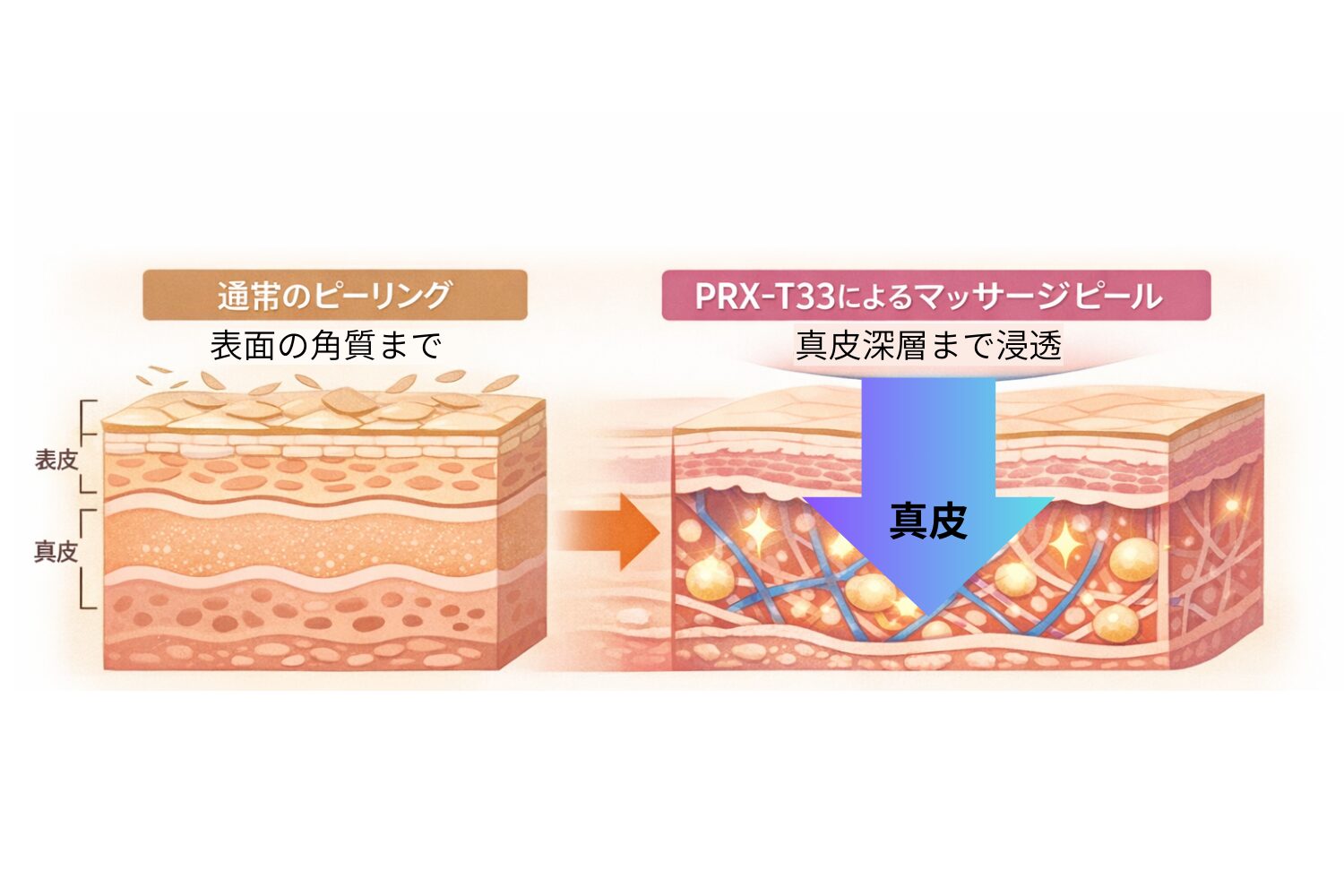 薬剤（PRX-T33）が真皮深層まで浸透する仕組み