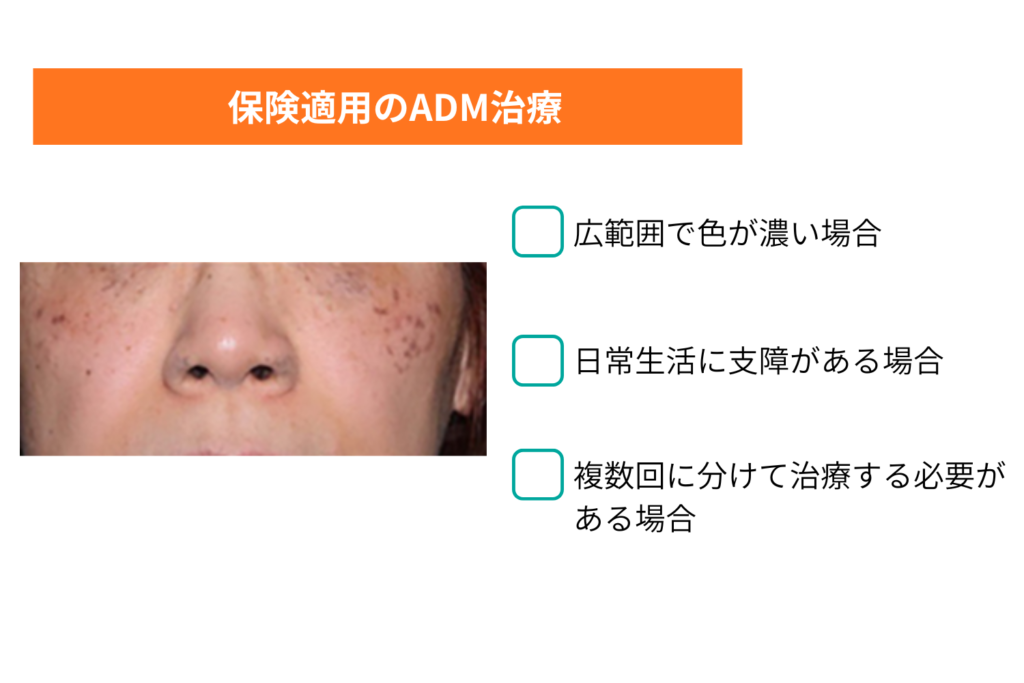 回数や条件で保険適用が変わる