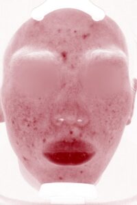 ニキビアフター