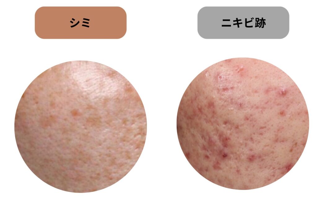 シミとニキビ跡の違いは「色・凹み・経過」で判断できる