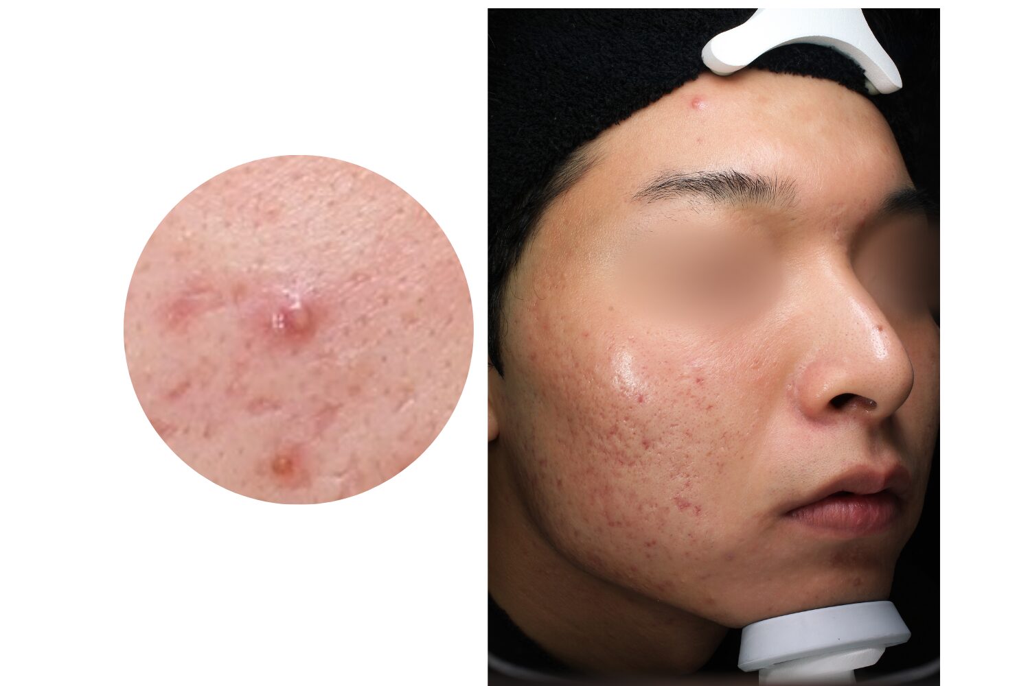 赤ニキビの治し方｜応急処置と皮膚科の治療を整理