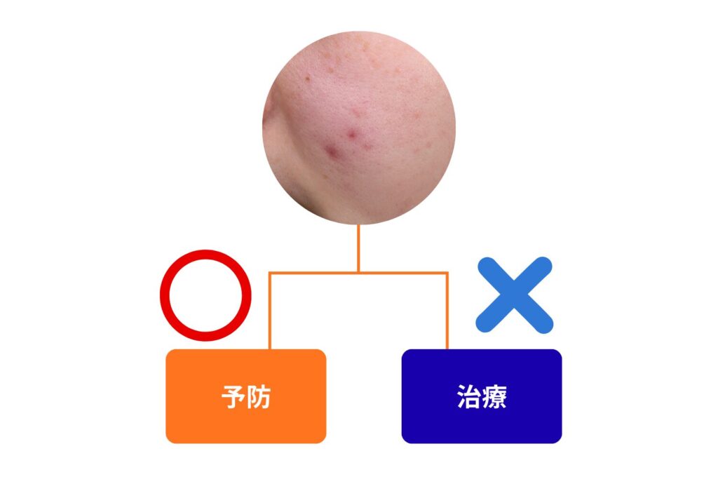 サウナはニキビを直接治す方法ではない