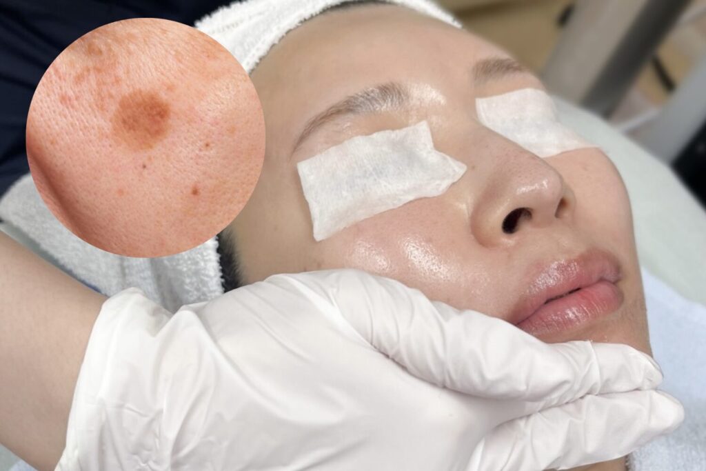 シミに効く?ケミカルピーリングの選び方