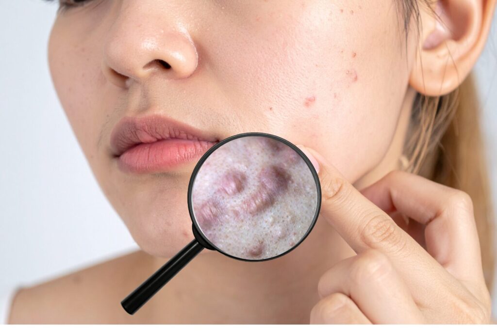 ニキビ跡のしこりの正体｜セルフケアと受診目安