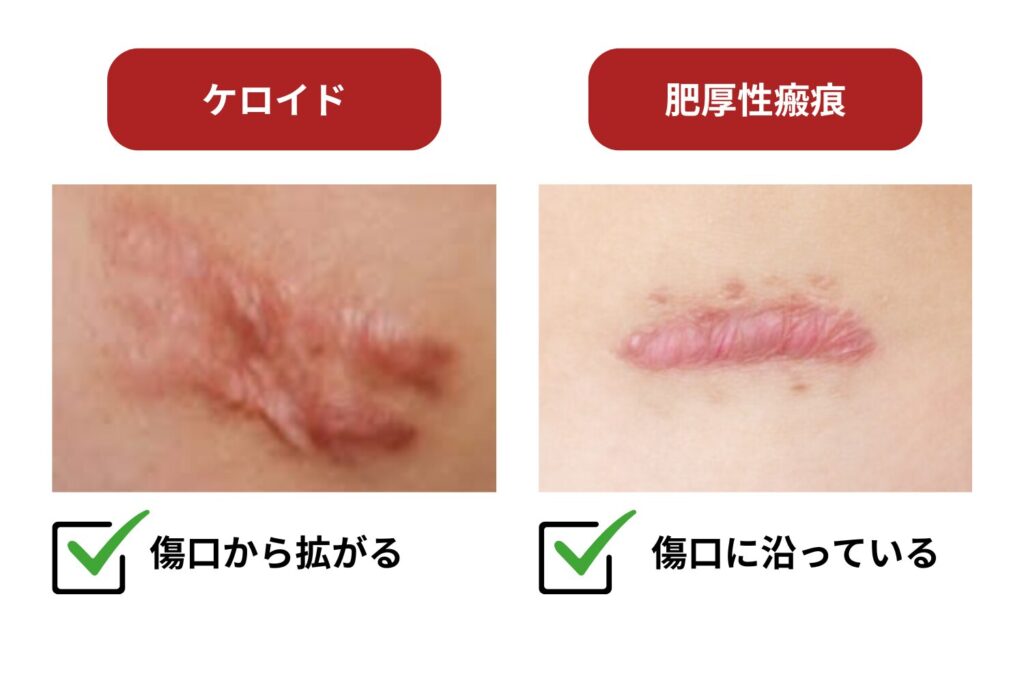ケロイドと肥厚性瘢痕の違い