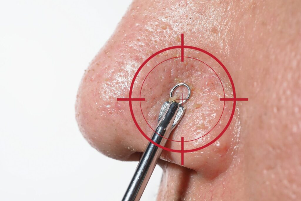 ニキビの角栓とは?原因と取る方法をやさしく整理