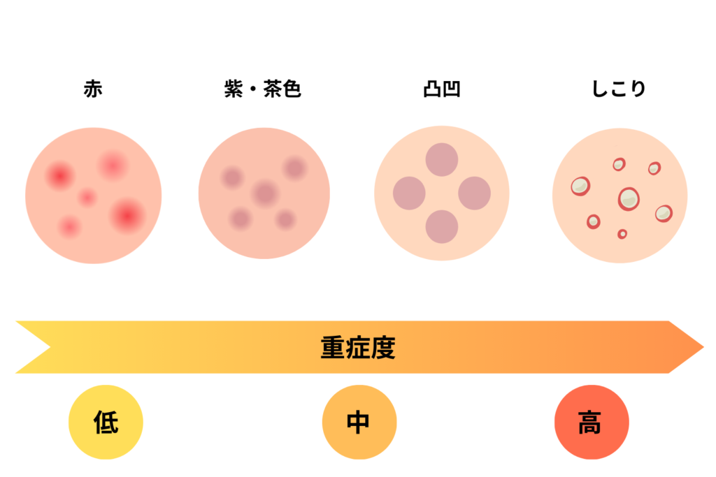 ニキビ跡の種類は主に4つ