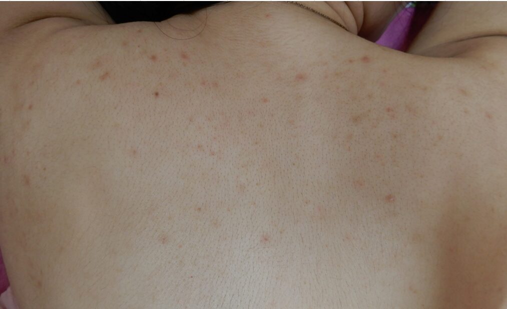 炎症後色素沈着