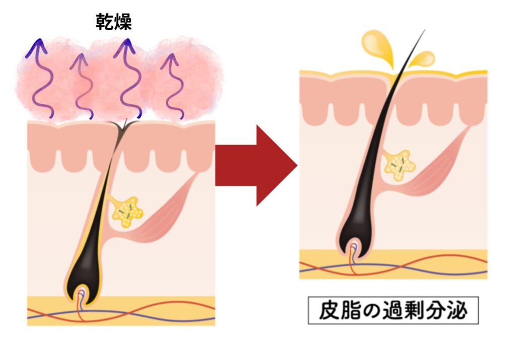乾燥が皮脂分泌と毛穴づまりを招く