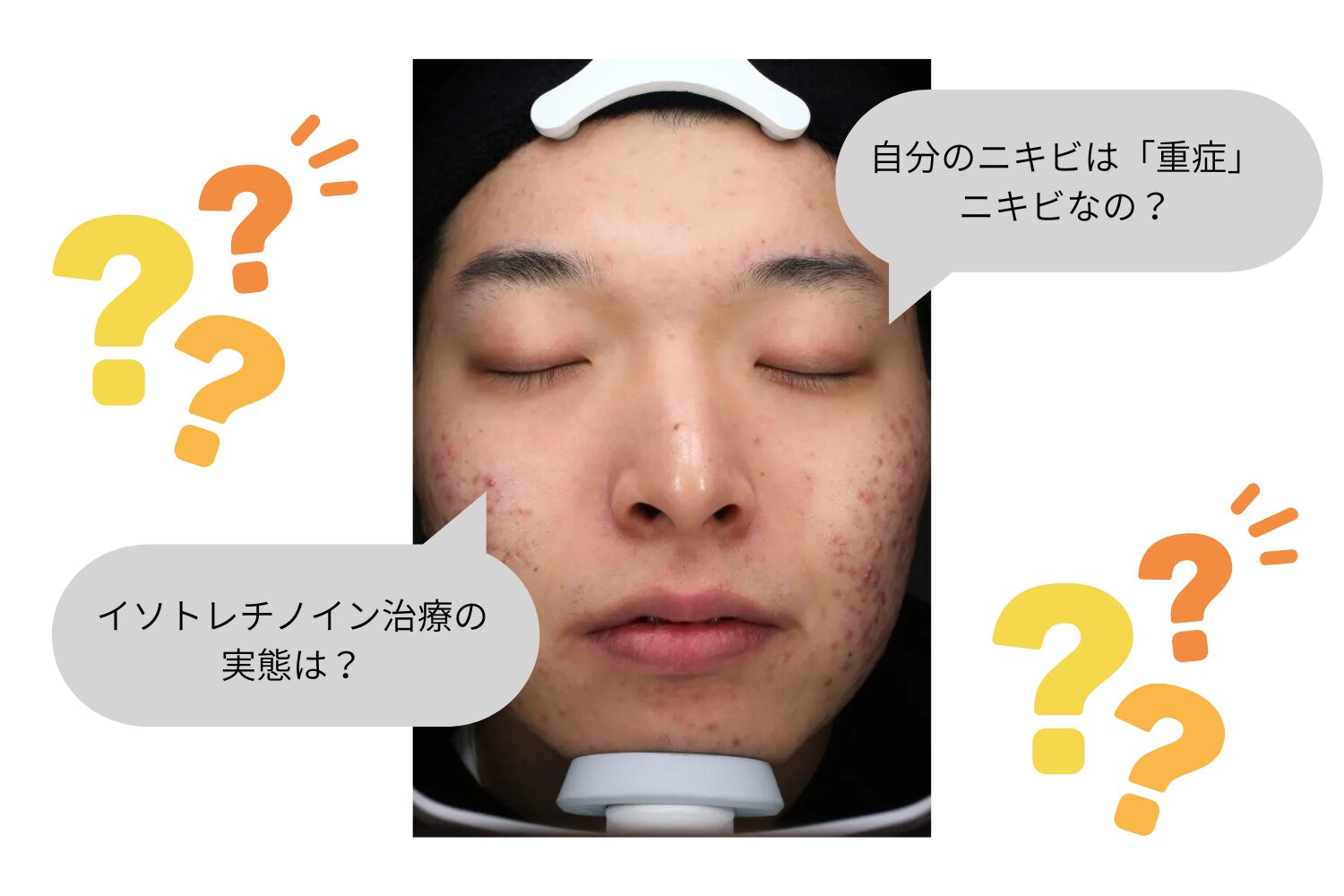 重症ニキビが治らない原因と対策