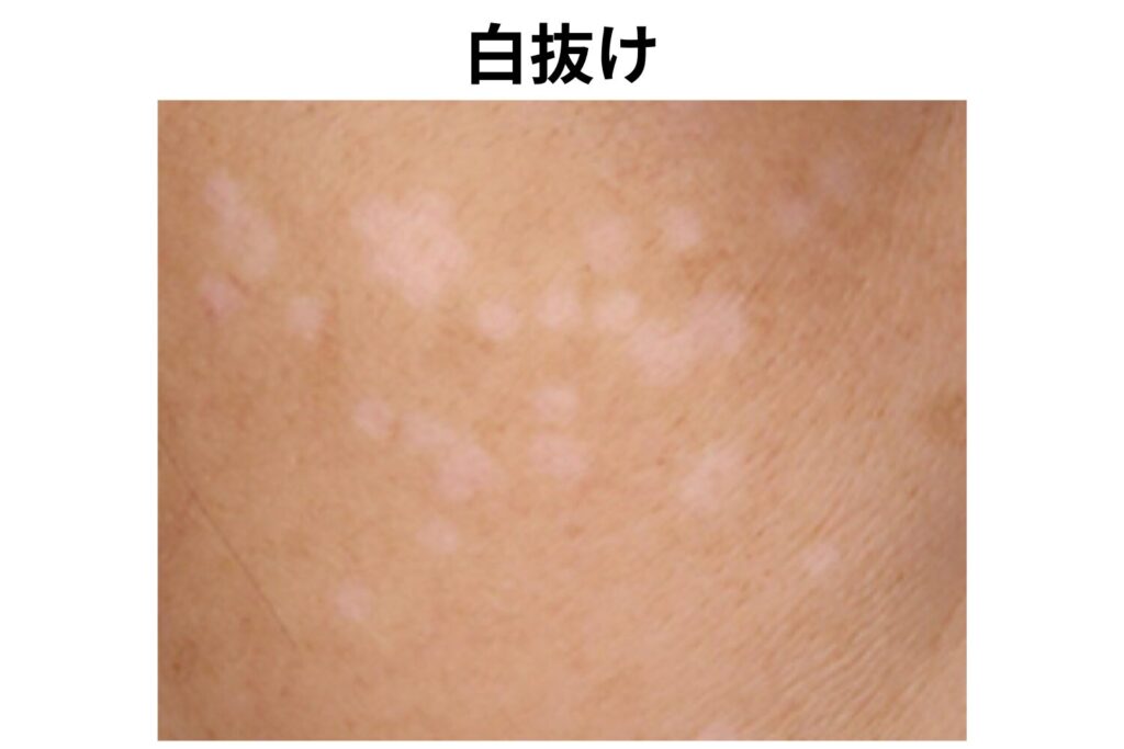 白抜けや肝斑悪化を防ぐための診断と出力調整