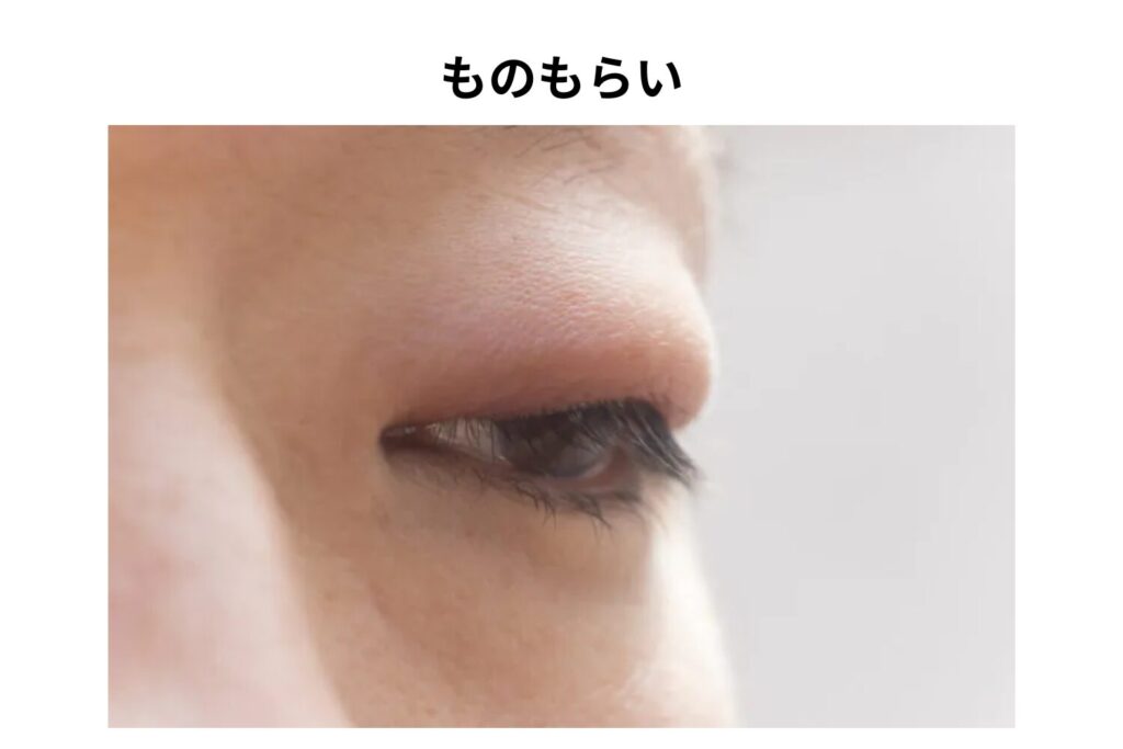 痛みや腫れが強い「ものもらい（麦粒腫・霰粒腫）」