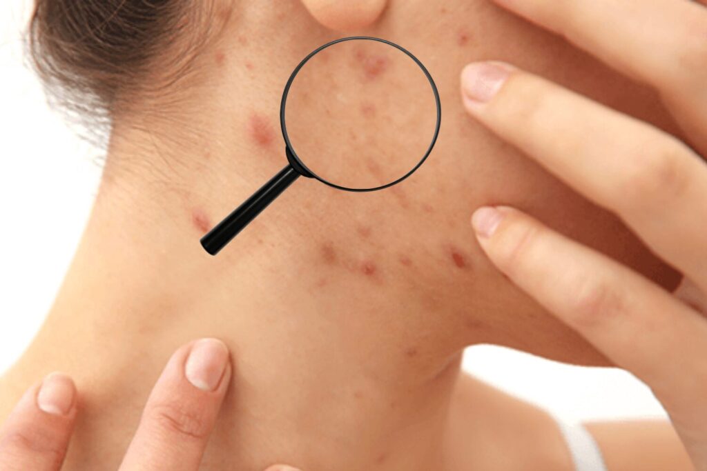 ニキビがもみあげにできる原因と対処法｜悪化を防ぐ判断軸