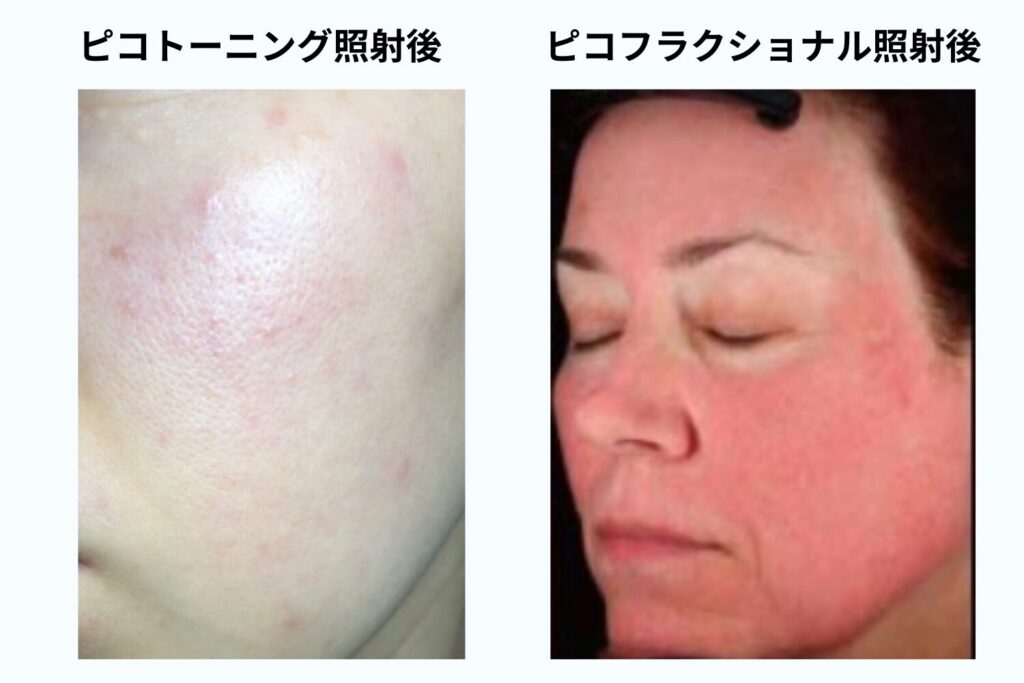 ピコトーニングとピコフラクショナルのダウンタイムの違い