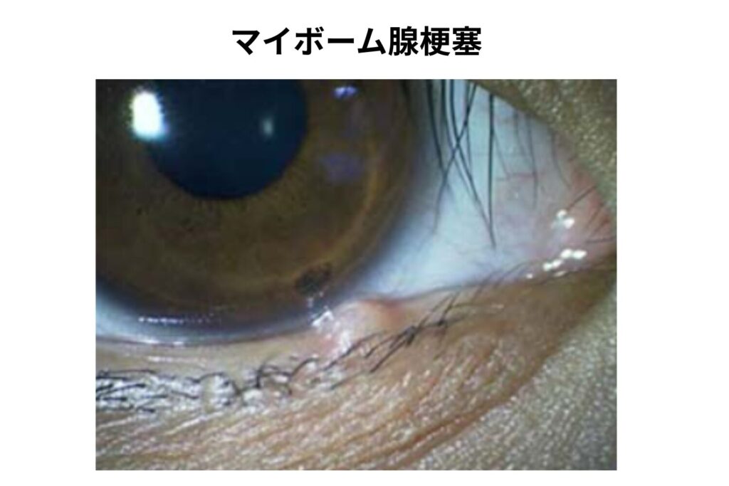 まつ毛の生え際にできる「マイボーム腺梗塞」