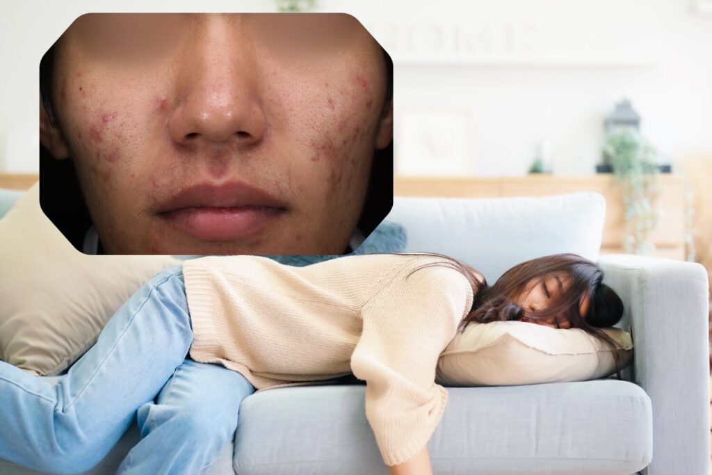 ニキビは寝不足で増える？原因と対策