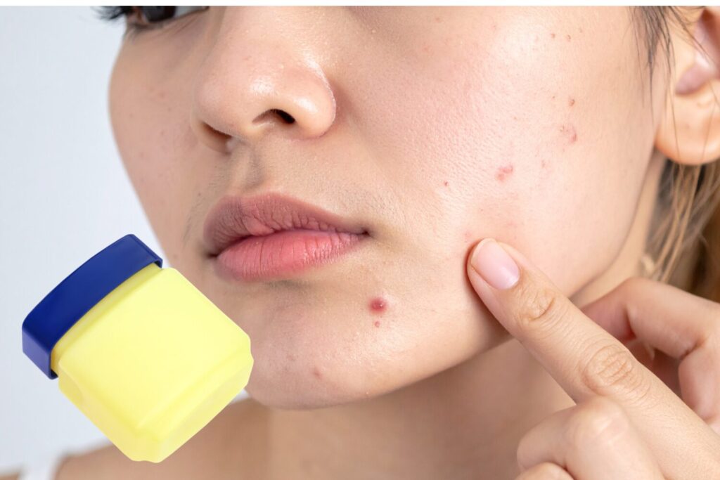 ニキビにワセリンは効果ある？正しい使い方と注意点