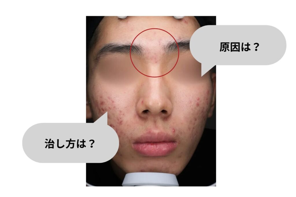 ニキビが眉間にできる原因と治し方|繰り返す前の対策
