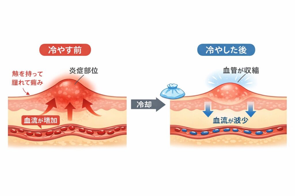 冷却で期待できるのは炎症と痛みの緩和