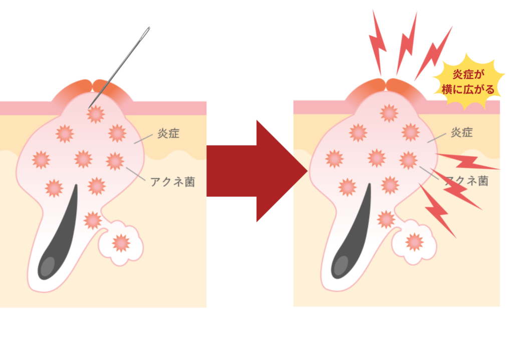 圧力で膿が広がり治りが遅くなる・遅くなる理由