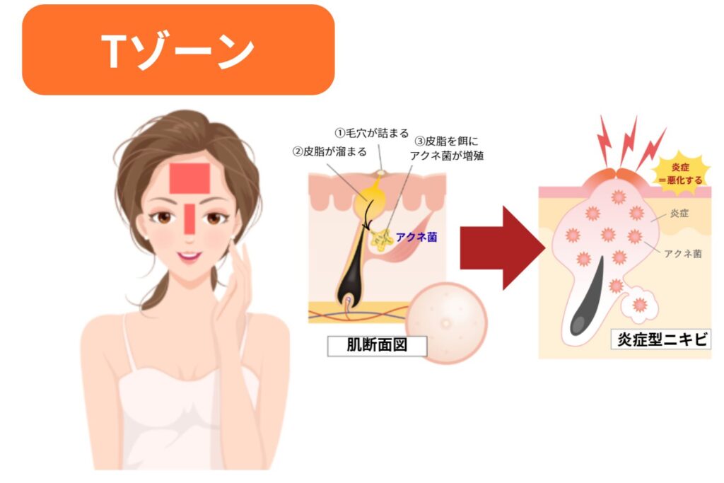 Tゾーン特有の皮脂分泌が影響しやすい