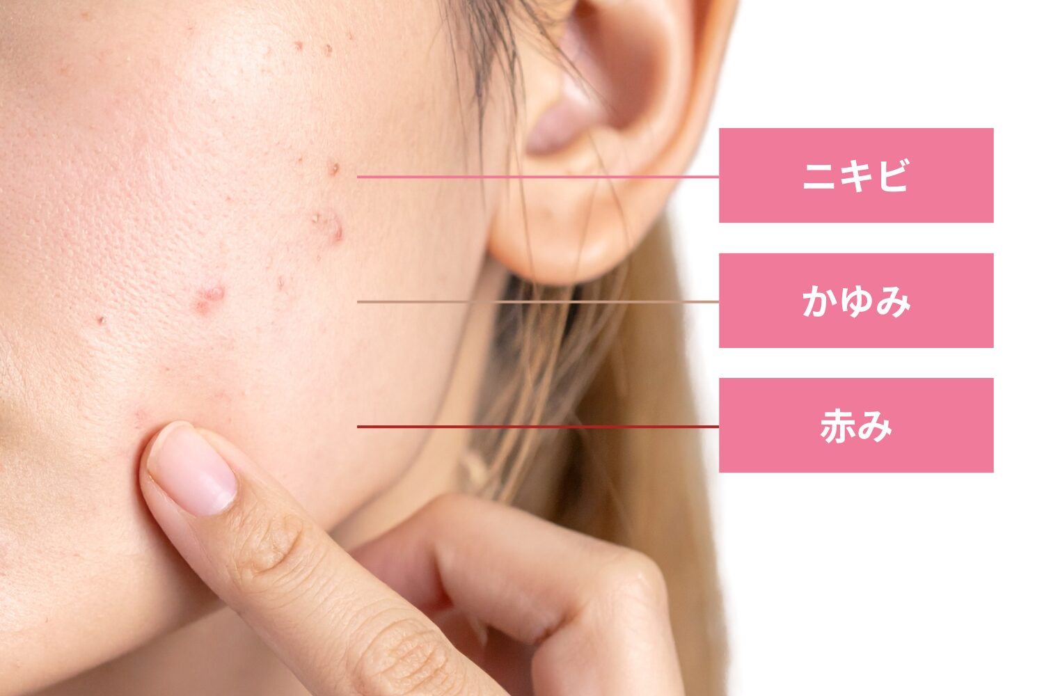 ニキビ治療で起こる好転反応の正体と見極め方