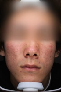 ニキビビフォー