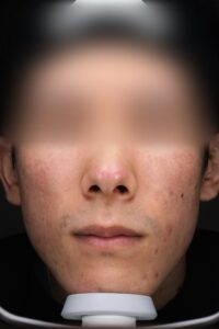 ニキビアフター