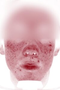 ニキビビフォー