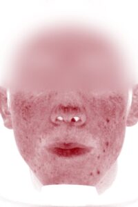 ニキビアフター