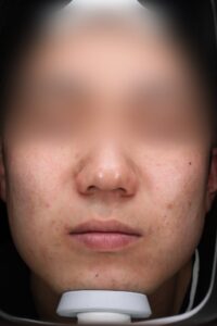 ニキビアフター