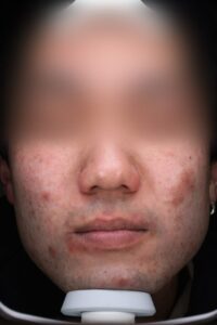 ニキビビフォー