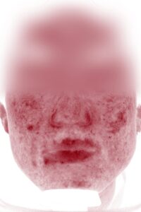 ニキビビフォー