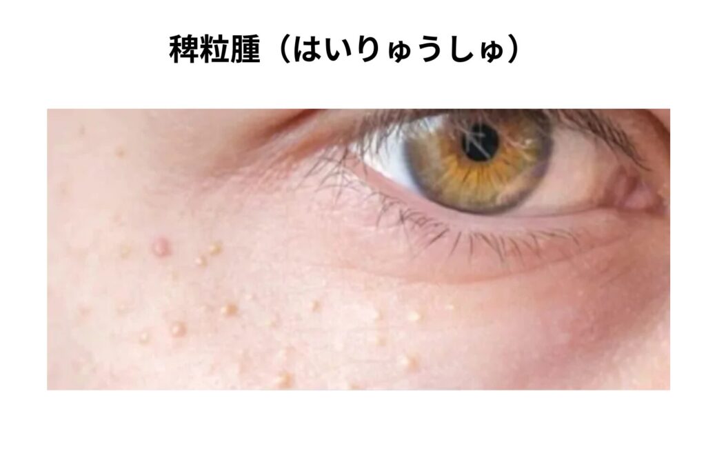 白くて硬いポツポツ「稗粒腫（はいりゅうしゅ）」