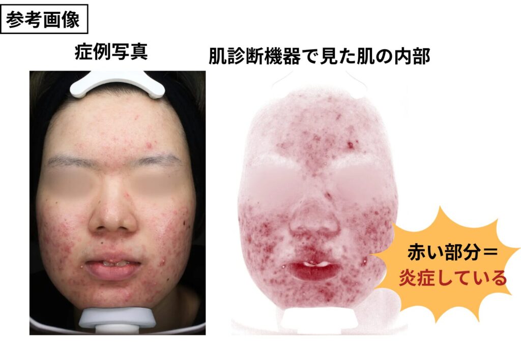 重症ニキビは炎症が深く自然治癒しにくい