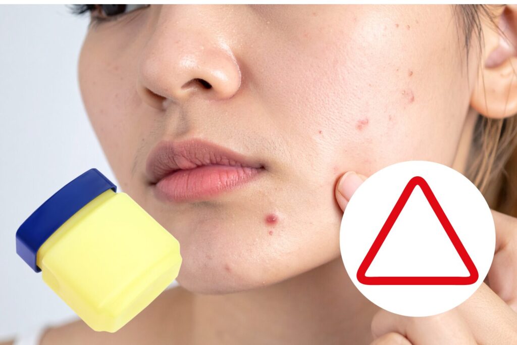 ニキビにワセリンは効果的？乾燥対策には有効だが炎症中は注意