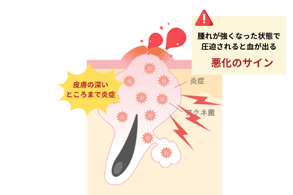 ニキビから血が出るのは炎症が強いサイン