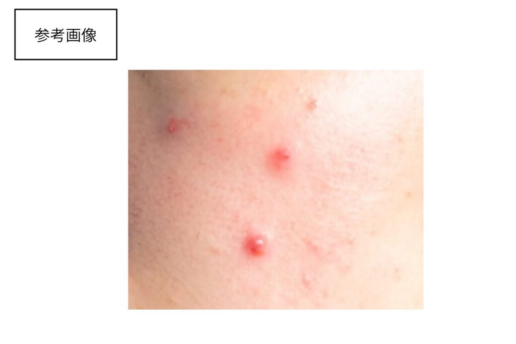 赤みやポツポツが出る初期症状の特徴