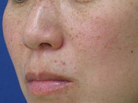 軽度の場合:外用治療と光治療