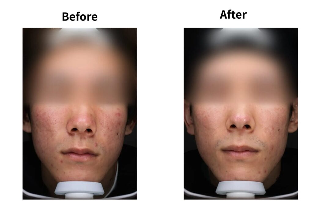 必要な施術回数の目安