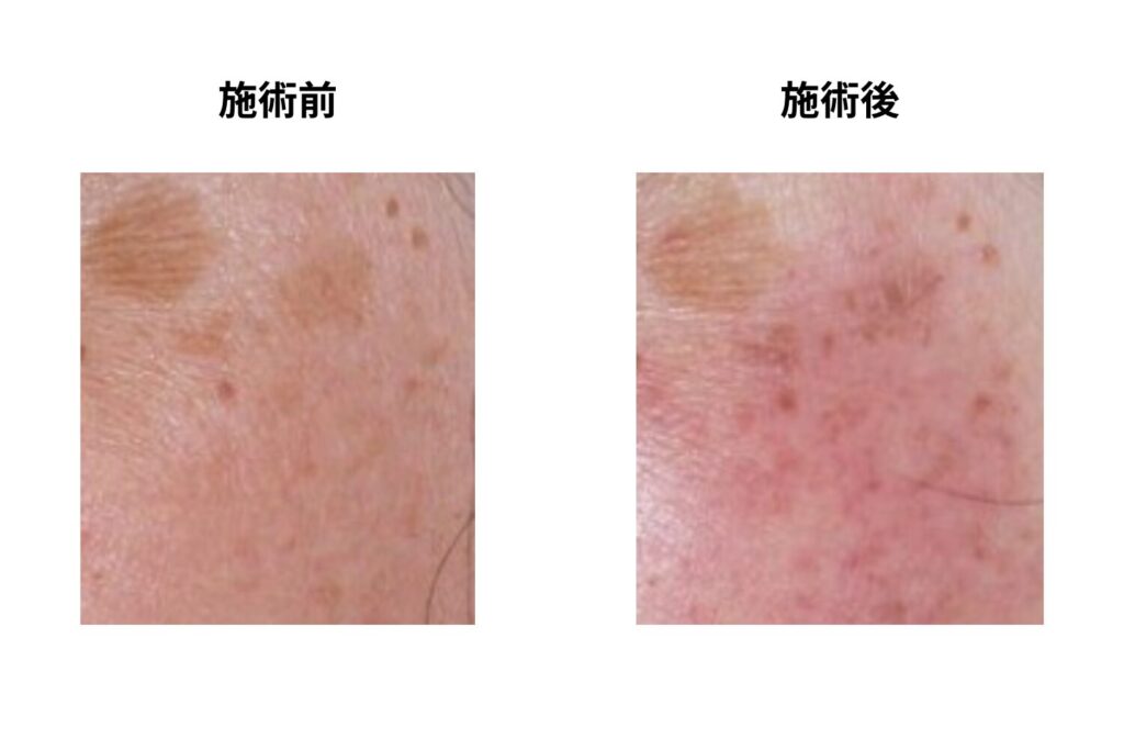 IPL（光治療）のダウンタイムとは？