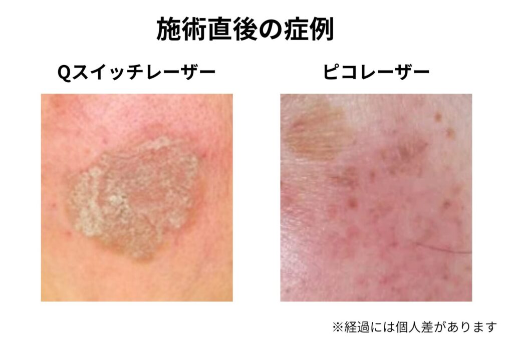 ダウンタイム・痛みの違い