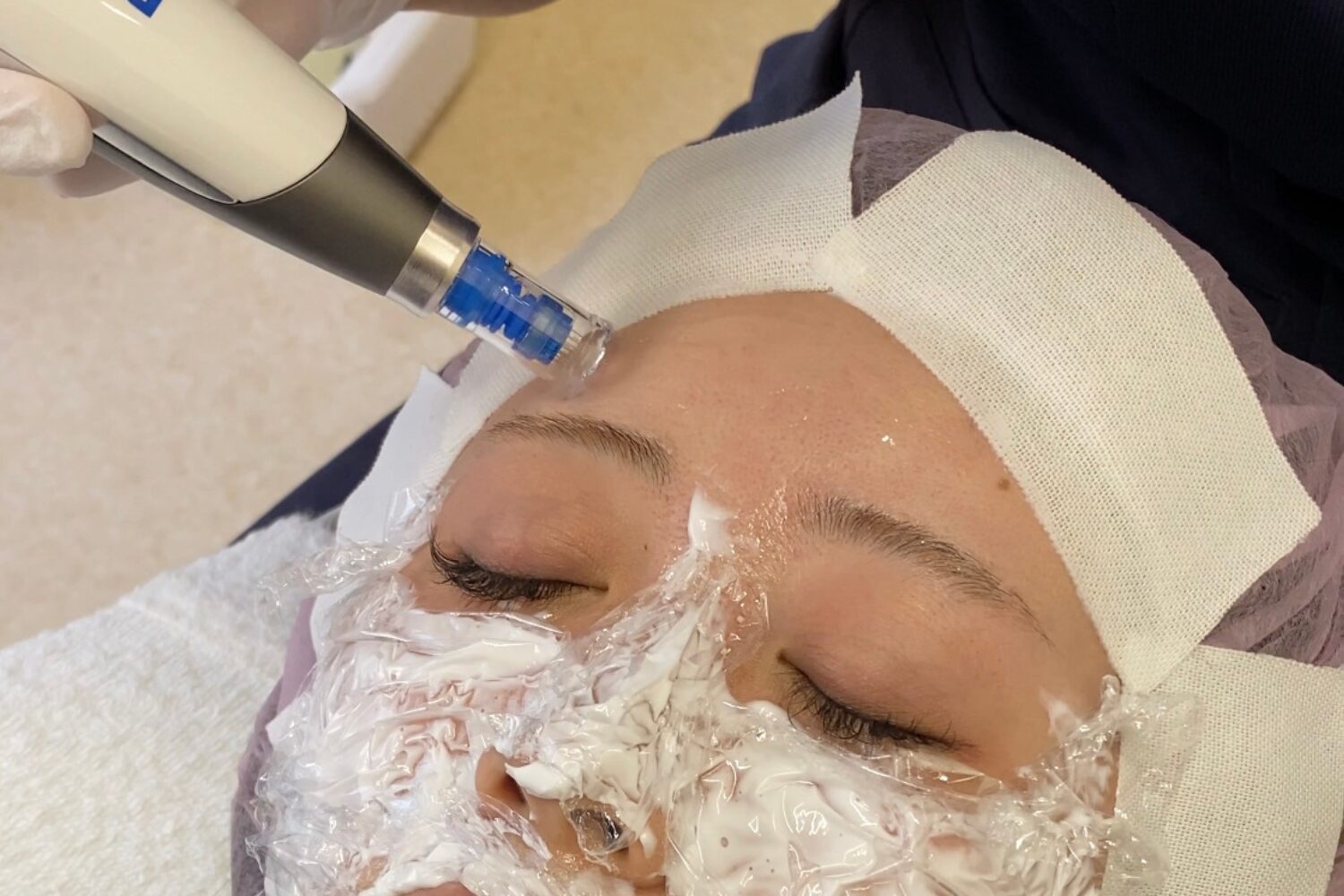 ニキビ跡にダーマペンは効果ある?効果・回数・治療の流れ