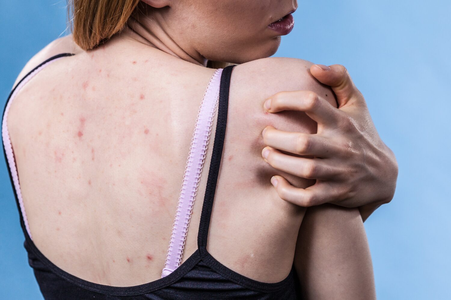 背中ニキビの予防につながる