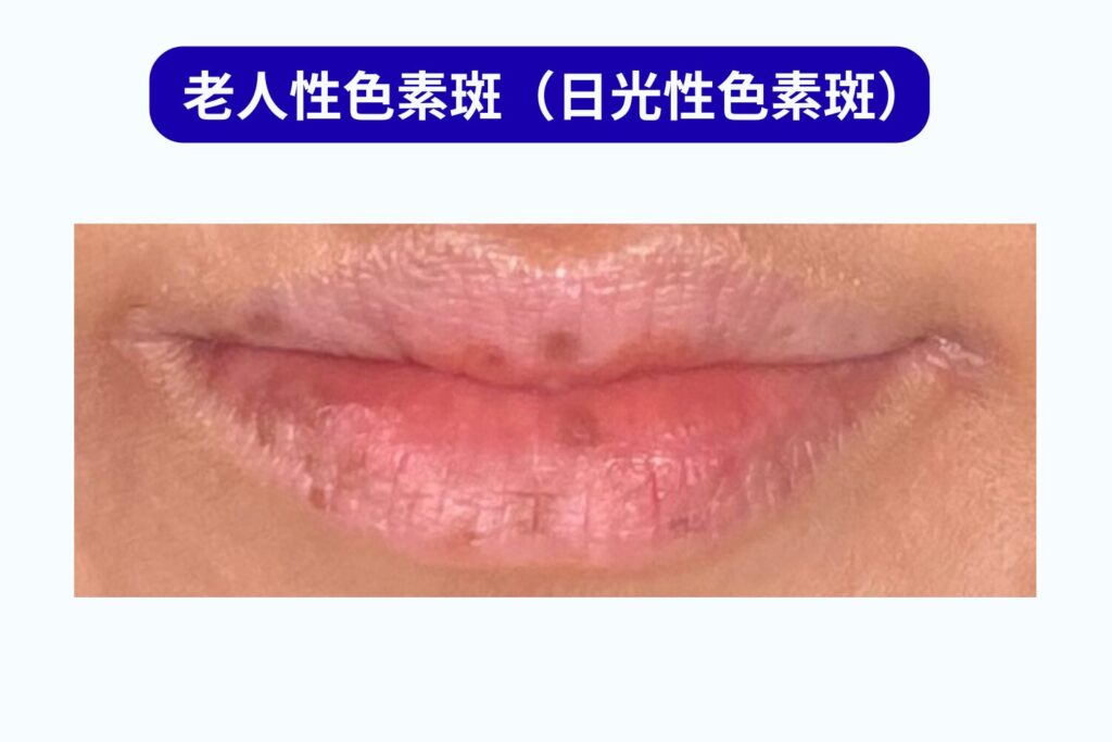 老人性色素斑（日光性色素斑）