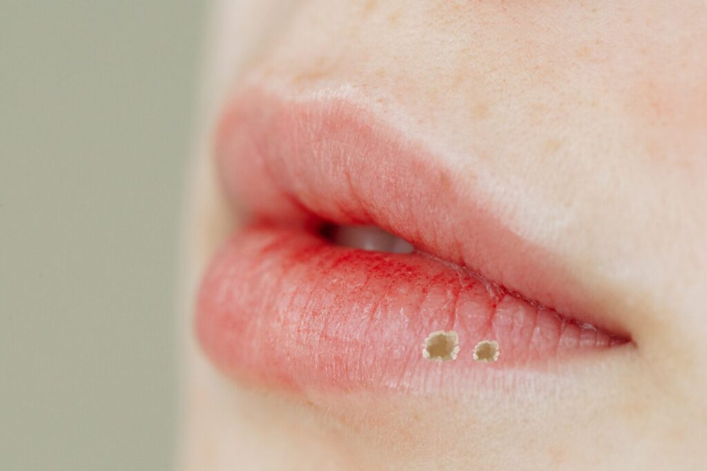 唇のシミ取り治療とは？種類・副作用・ダウンタイムを解説